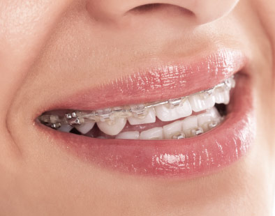 brackets-zafiro
